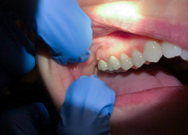 Best Emergency Dental Care for Broken or Chipped Teeth in Mantua, VA